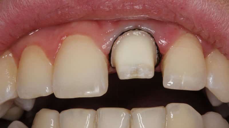 Что делать, когда болит зуб под коронкой – стоматологическая клиника «Имплант Лаб»