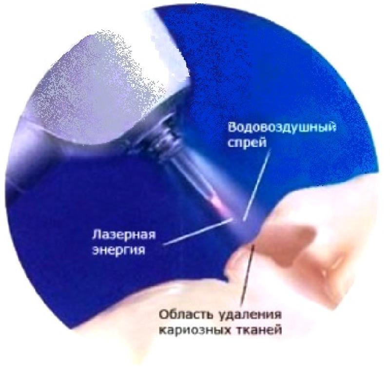 Лазерное лечение зубов красноярск thumbnail