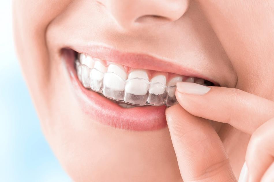 ᐉ Стоматологическая капа для выравнивания зубов Краматорску